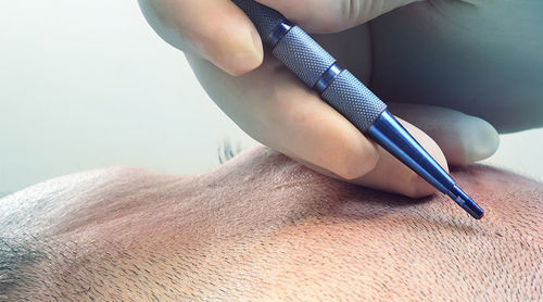 Latest company news about Application of Sapphire Blades in Hair Transplant Surgery